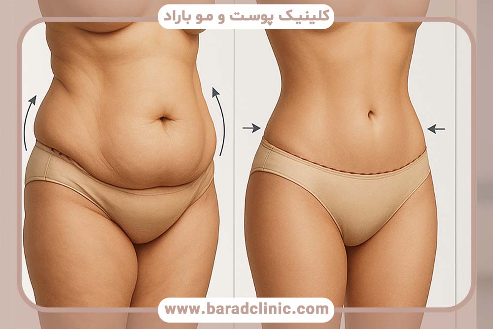 برنامه ورزشی قبل از لیفت بدن