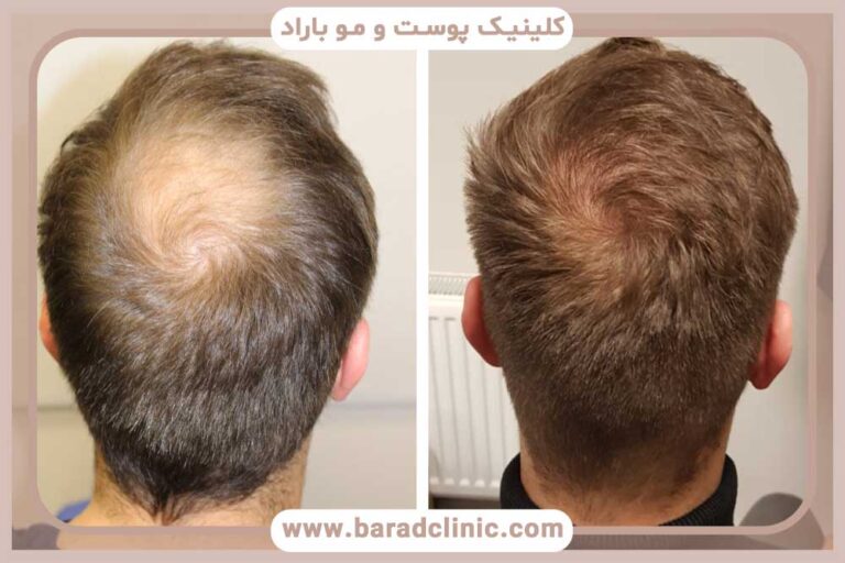 The difference between natural hair transplantation and hair restoration