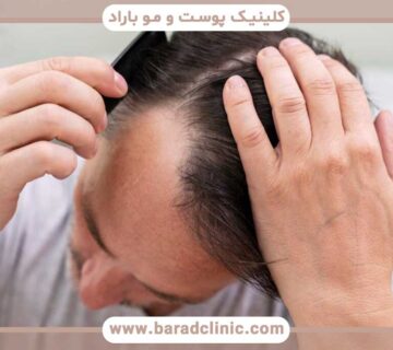 The effect of stress on hair transplant results