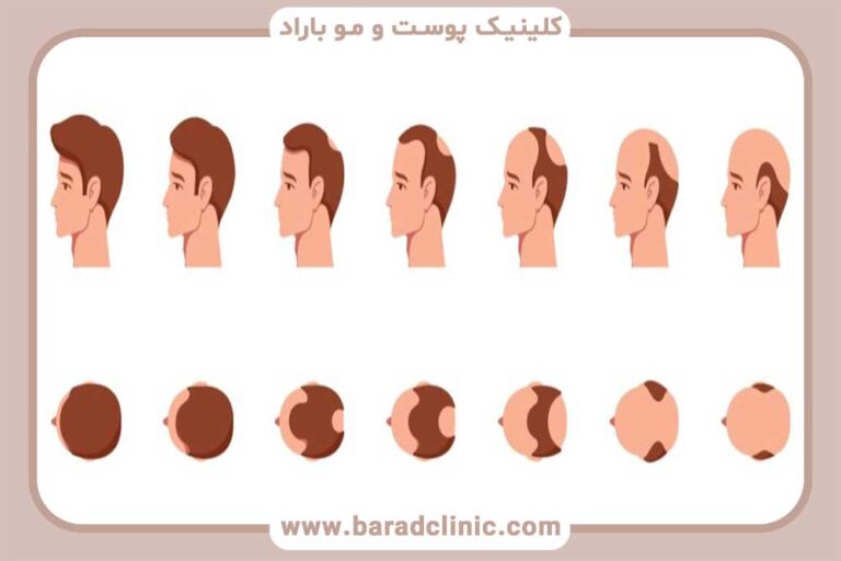 Hair growth after transplantation