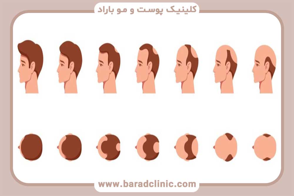Hair growth after transplantation