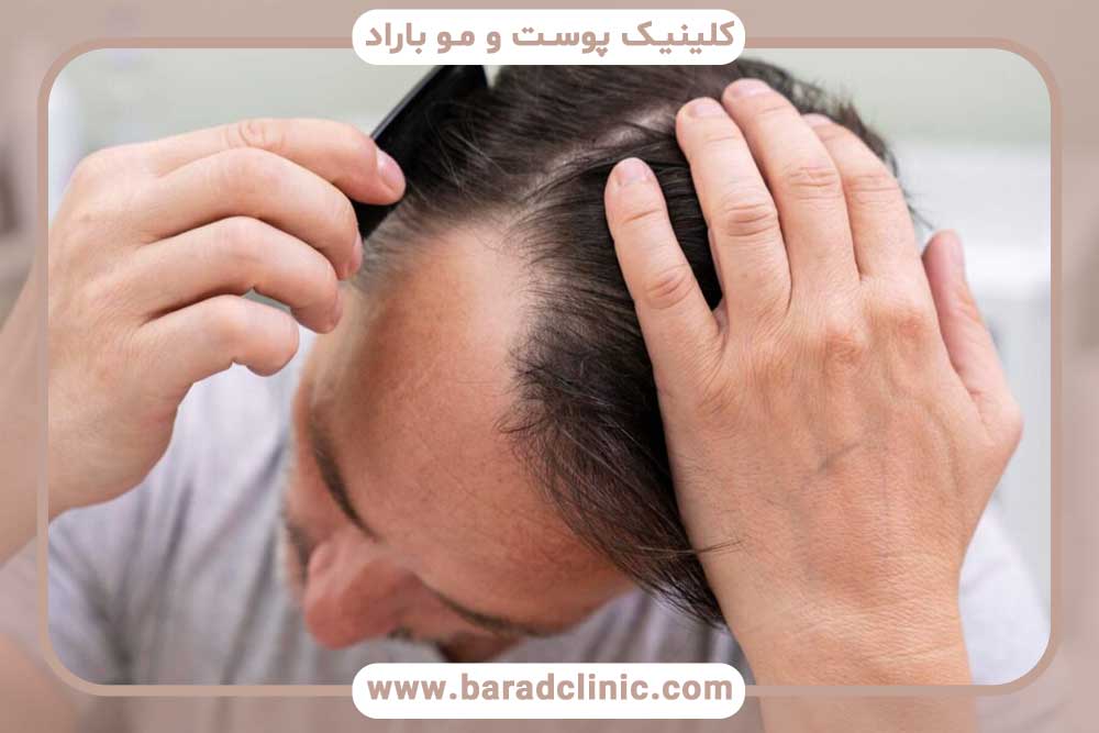 The effect of stress on hair transplant results