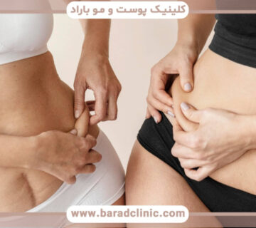 تفاوت پیکرتراشی و لیپوساکشن کلاسیک