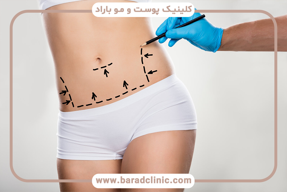 لیفت بدن در بیماران با پوست شل شدید