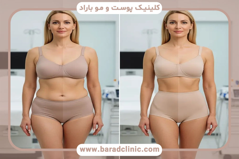 لیفت بدن دقیقاً چگونه انجام می‌شود؟