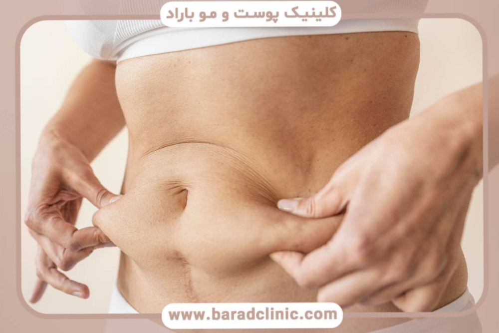 لیفت بدن برای افراد با پوست‌های نازک