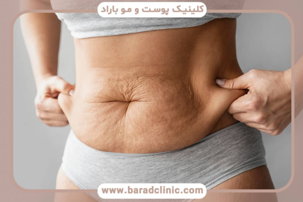 لیفت بدن کامل