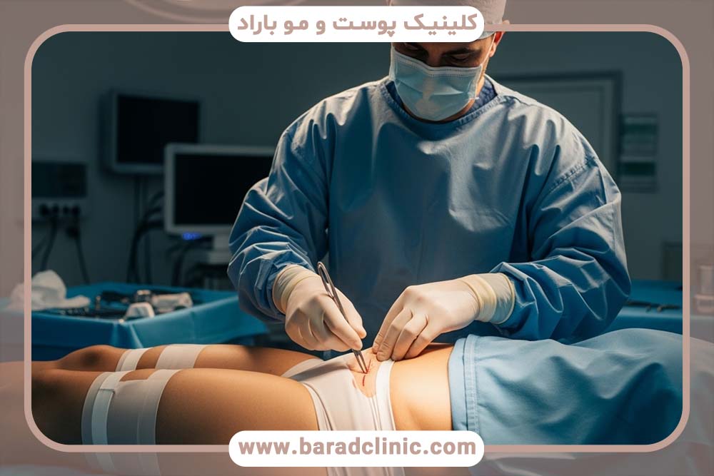 لیفت بدن ۳۶۰ درجه (Circumferential)