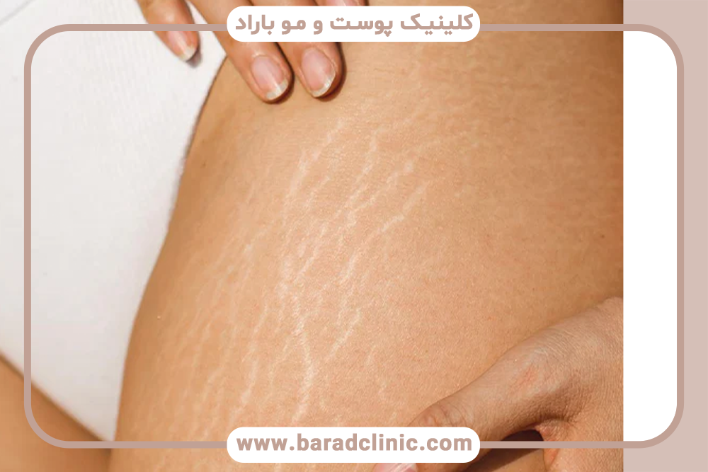 لیفت بدن در نواحی ترک پوستی