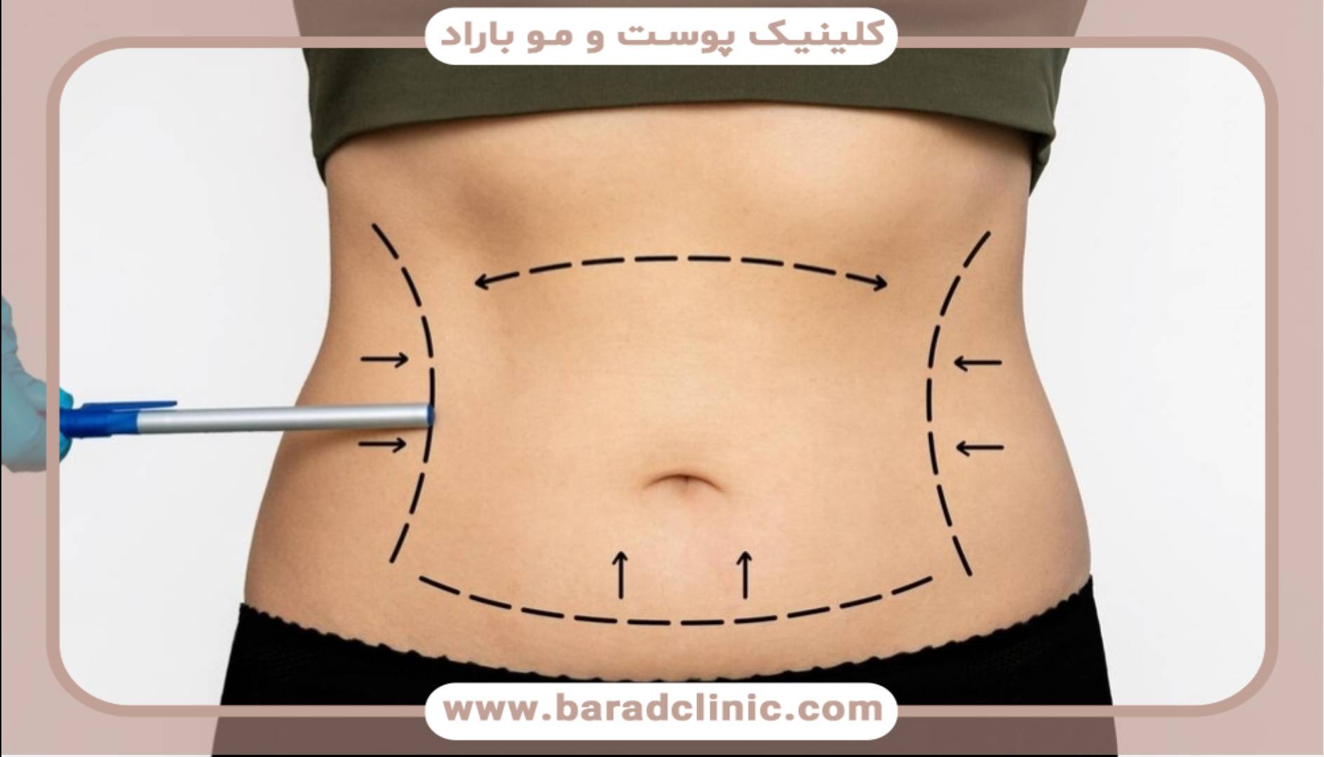 لیفت بدن برای درمان شلی پوست پس از بارداری