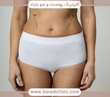 پیکرتراشی شکم و پهلو (تورسوپلاستی)