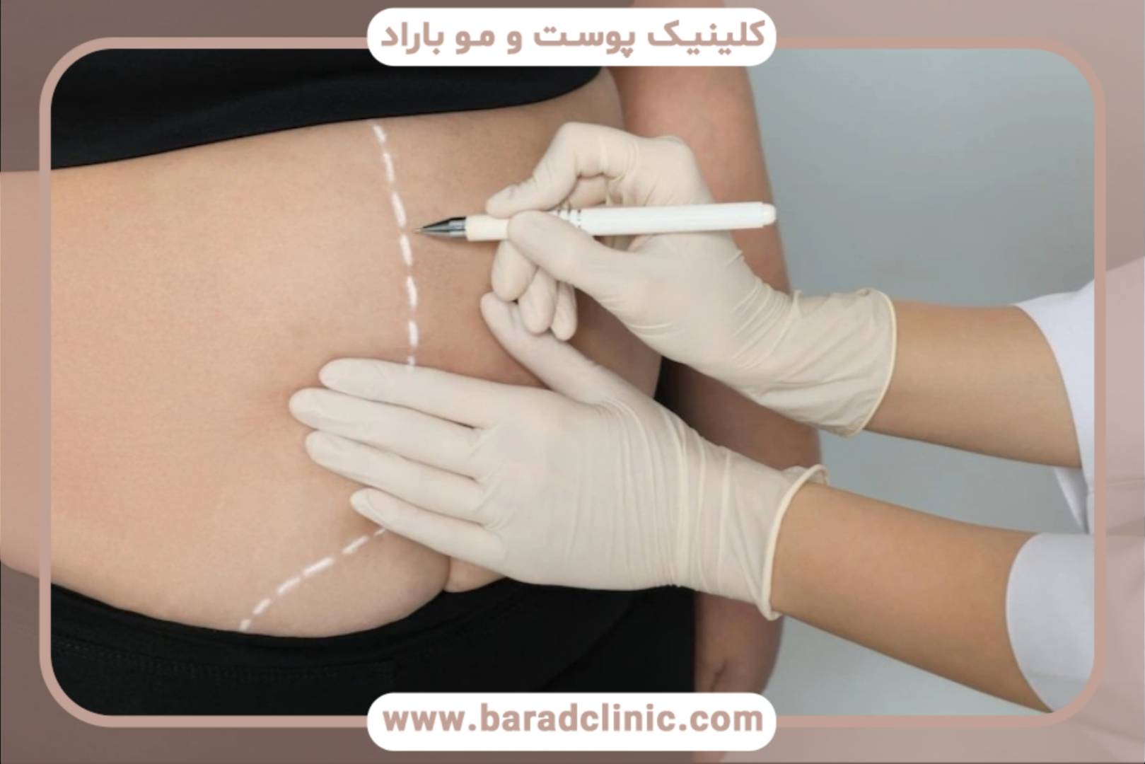 لیفت بدن با تکنیک عضله‌سازی (Muscle Plication)