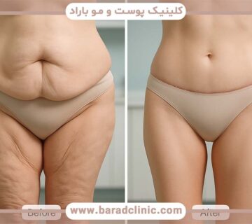 مشاوره اولیه لیفت بدن (۱۵ سوال حیاتی)