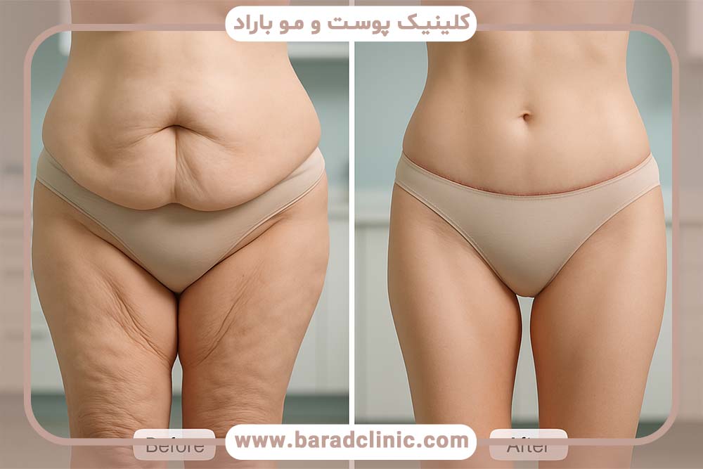 مشاوره اولیه لیفت بدن (۱۵ سوال حیاتی)