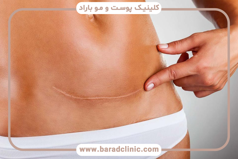 تکنیک‌های کاهش اسکار در لیفت بدن