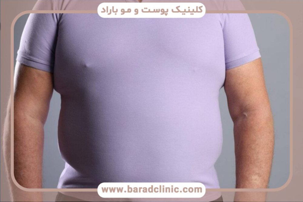 ژنیکوماستی