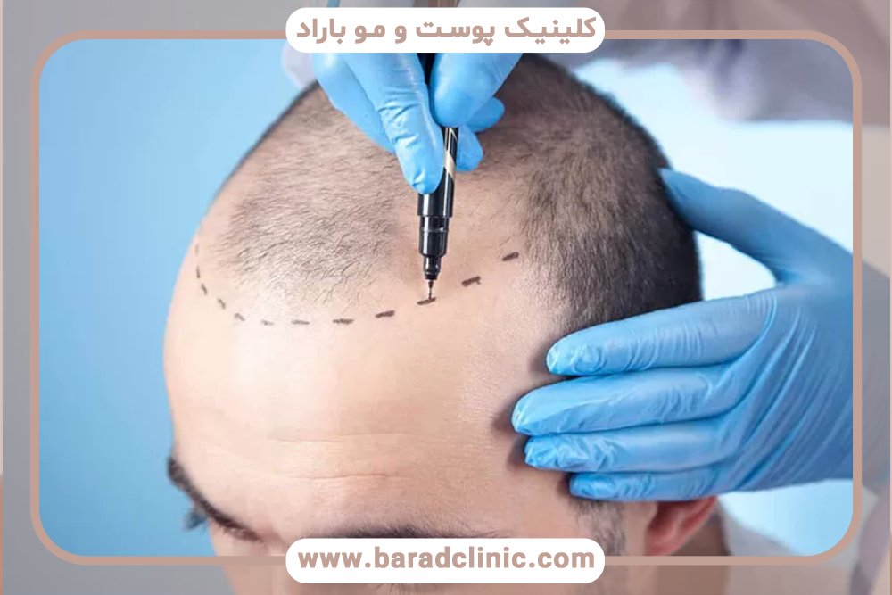 رازهای موفقیت در کاشت مو طبیعی