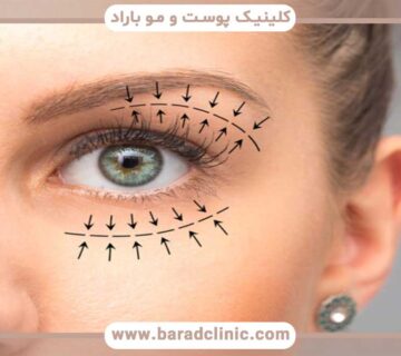 The right age for blepharoplasty