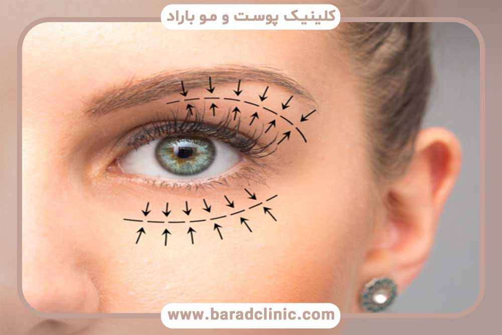 The right age for blepharoplasty
