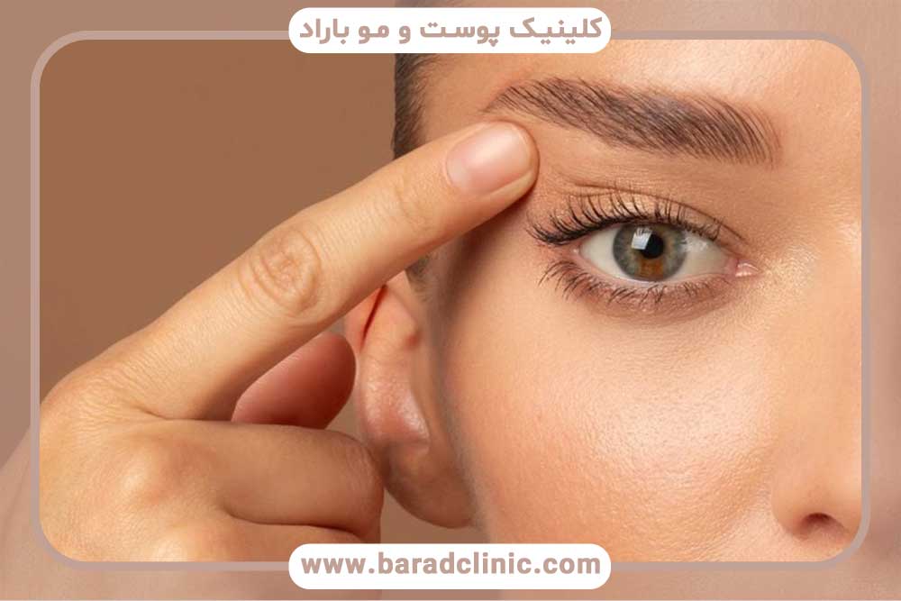 Blepharoplasty