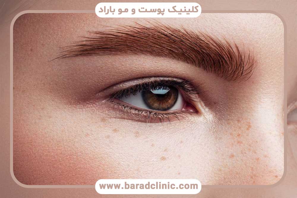 Eyebrow shaping with implants