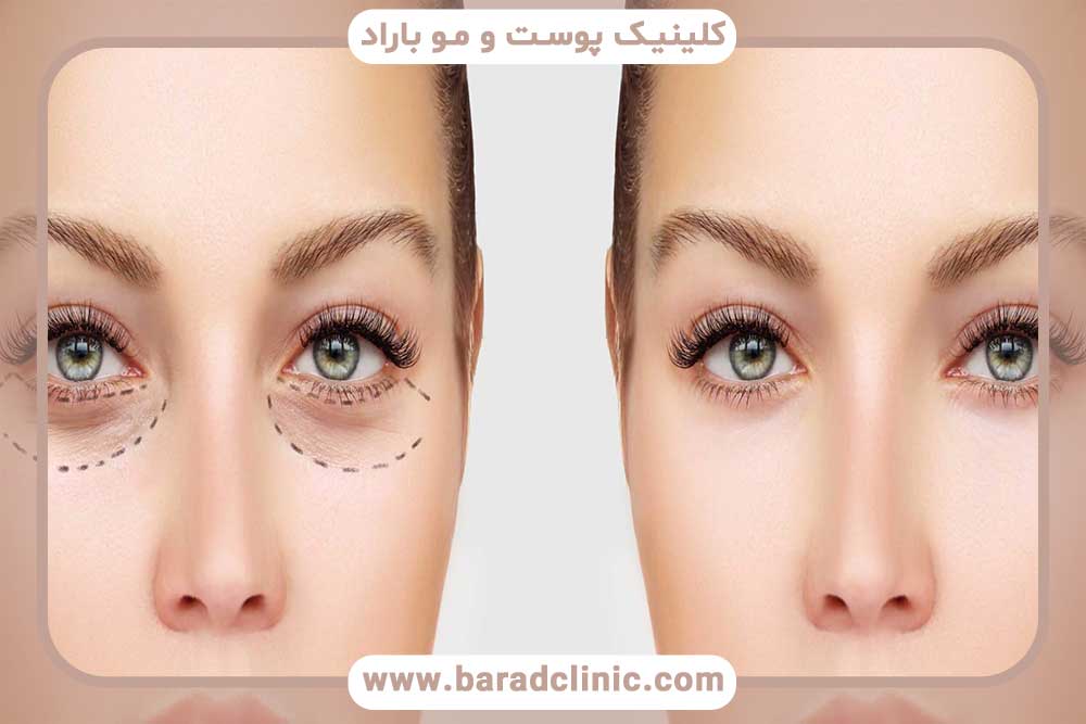 Blepharoplasty