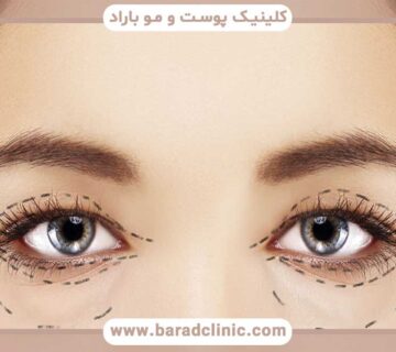 Non-surgical blepharoplasty