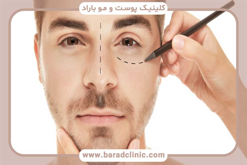 Blepharoplasty for men