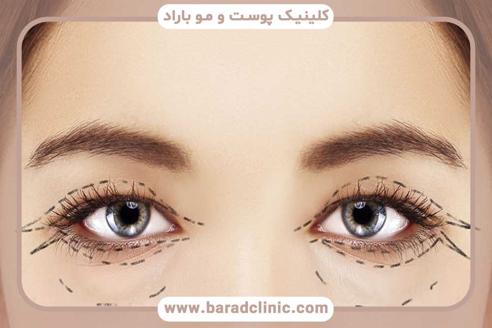 Non-surgical blepharoplasty