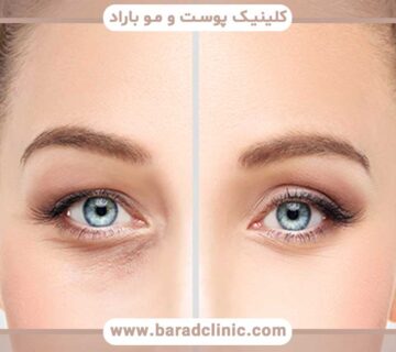 Blepharoplasty in young and old people