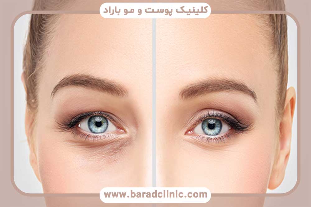 Blepharoplasty in young and old people