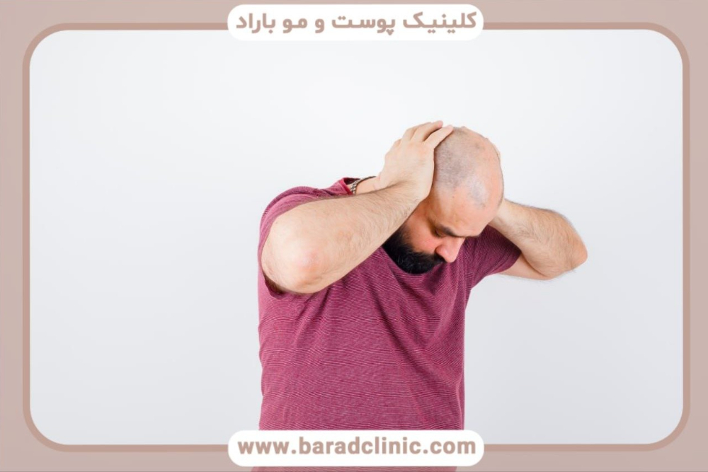 بهترین روش کاشت مو