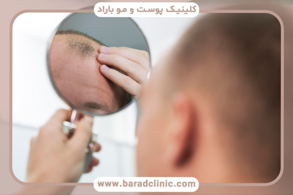 بهترین کلینیک کاشت مو در تهران