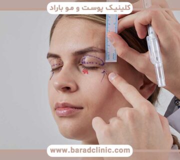 Comparing blepharoplasty with plasmajet