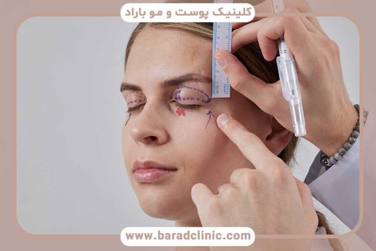 Comparing blepharoplasty with plasmajet
