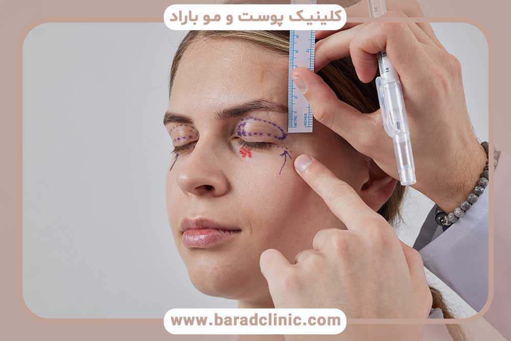 مقایسه بلفاروپلاستی با پلاسماجت