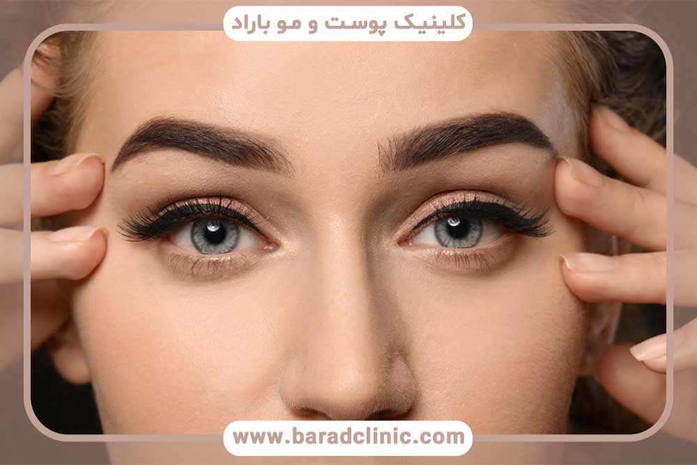 Long-term results of eyebrow transplantation