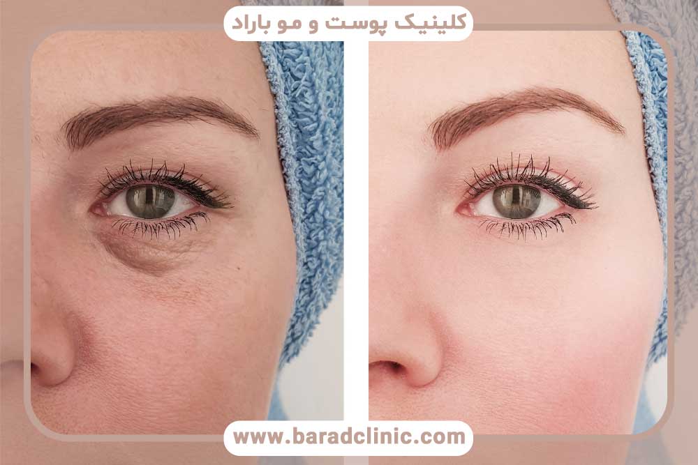 Natural results of blepharoplasty