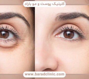 Return of blepharoplasty results