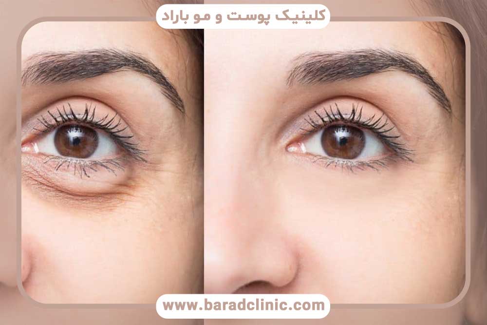 Return of blepharoplasty results