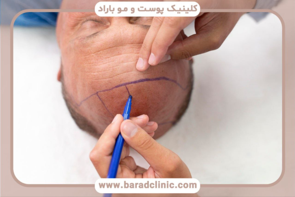 راهنمای انتخاب بهترین مرکز کاشت مو در تهران