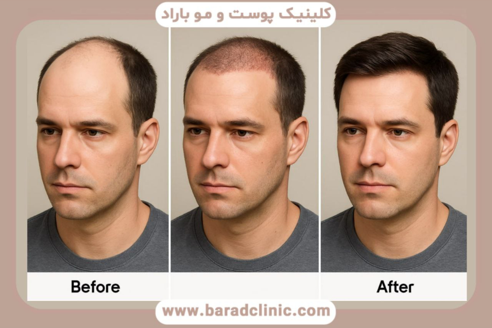 عکس ریزش مو بعد از کاشت