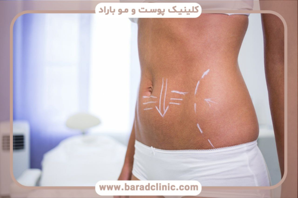 قش-ژنتیک-در-نتایج-پیکرتراشی