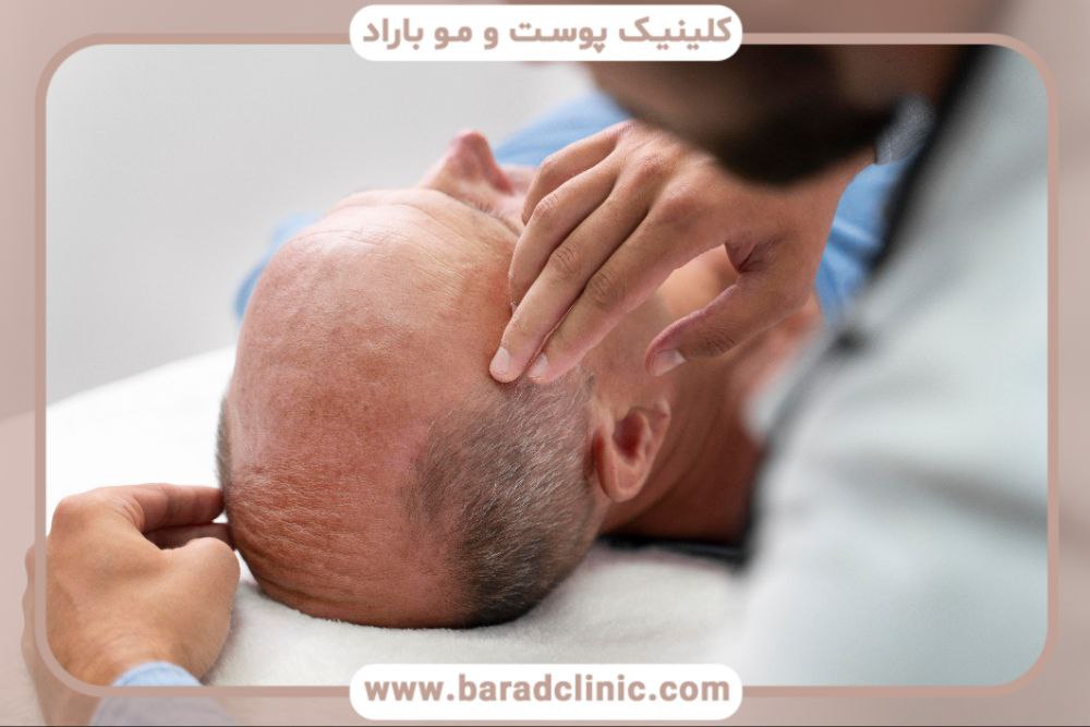 هزینه کاشت مو