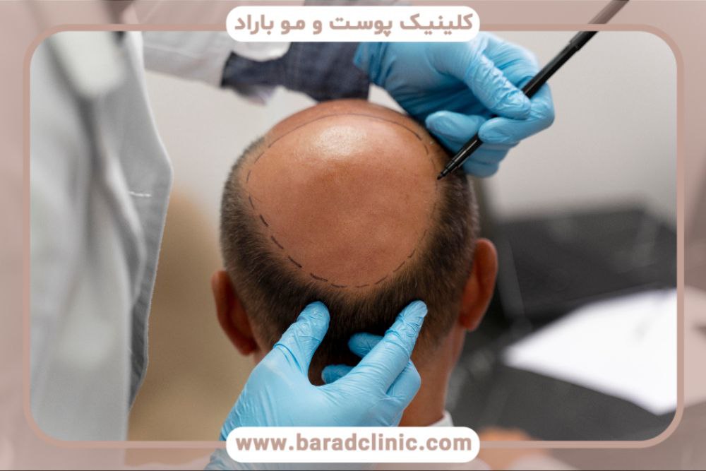 هزینه کاشت مو