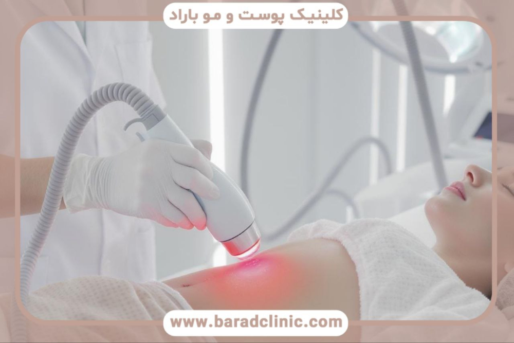 پیکرتراشی-لیزری