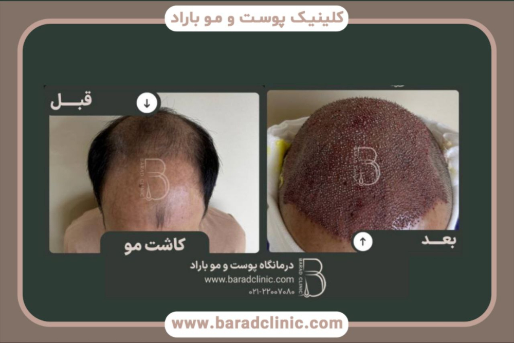 کاشت مو قبل و بعد