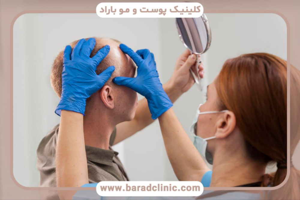 کاشت مو ناموفق