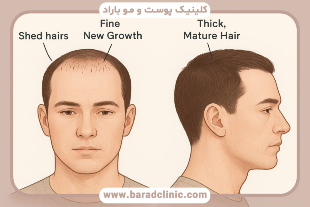 ۴۰ روز بعد از کاشت مو