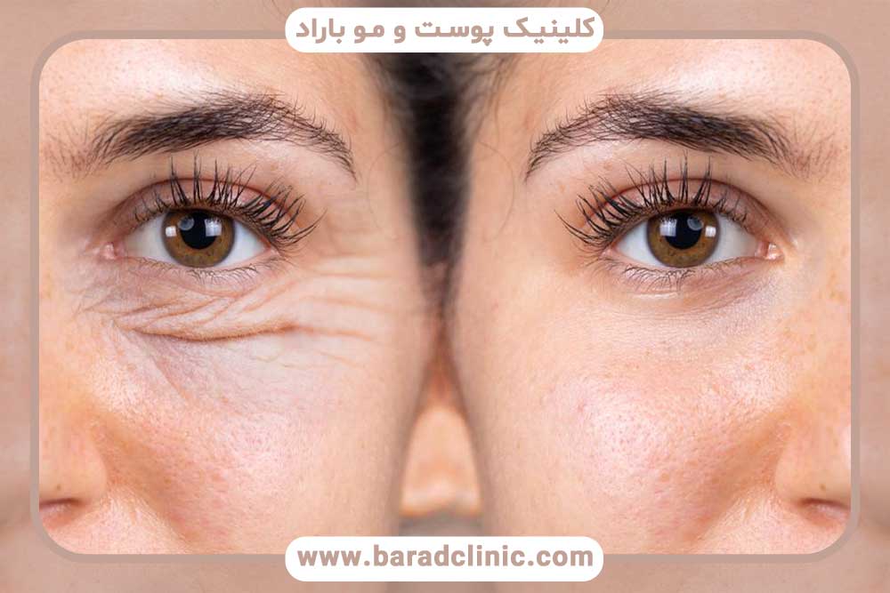 جوانسازی چشم‌ها با بلفاروپلاستی با قبل و بعد جراحی